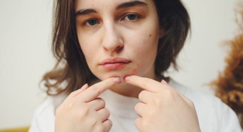 A young person with medium-length brown hair is looking directly at the camera, displaying a serious expression. They are pointing to their chin with both hands, highlighting a few blemishes on their skin. The background is neutral, with soft lighting that emphasizes their facial features. The individual is wearing a plain white shirt.
